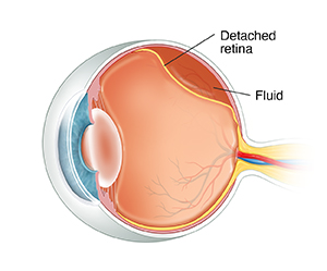 What Are Retinal Tears And Detachments Saint Luke S Health System