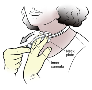 Discharge Instructions Caring For Your Tracheostomy Tube And Stoma