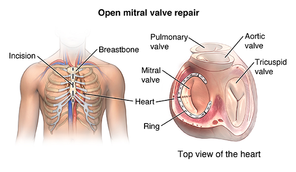 Open Mitral Valve Repair Saint Luke S Health System