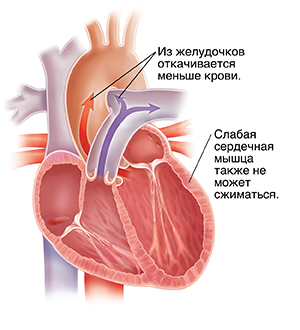 Поперечное сечение растянутого сердца с систолической сердечной недостаточностью.