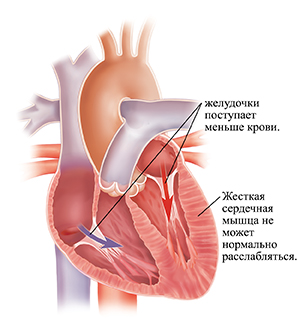 Поперечное сечение сердца с диастолической сердечной недостаточностью.
