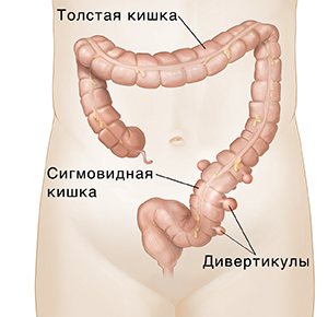 Вид спереди ободочной кишки с дивертикулами в нижней части.
