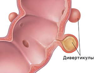 Поперечное сечение сигмовидной кишки с дивертикулитом.