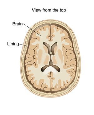 3-89205	Meningitis	Illustration	Medical illustration				Top view cross section of brain showing lining.