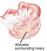 Complications of Pelvic Inflammatory Disease (PID) | YourCareEverywhere