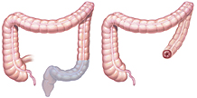 Abdominal perineal resection