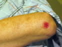 Abrasion on Elbow