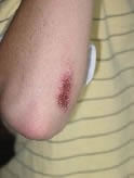 Abrasion on Elbow (3 Days Old)