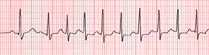 An ECG recording of an irregular heartbeat during an event.