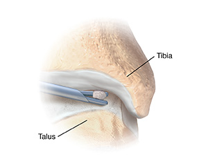 Closeup of instrument removing loose body from ankle joint.