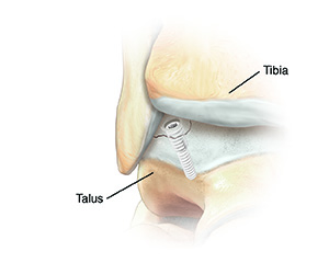Anterior view of foot showing screw holding cartilage in place on ankle bone or removal of the loose piece and placement of canals for cartilage regrowth.
