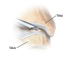 Anterior view of foot with burr removing bone spur on ankle bone.