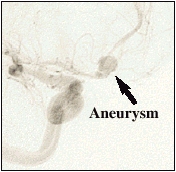 Arteriogramof aneurism