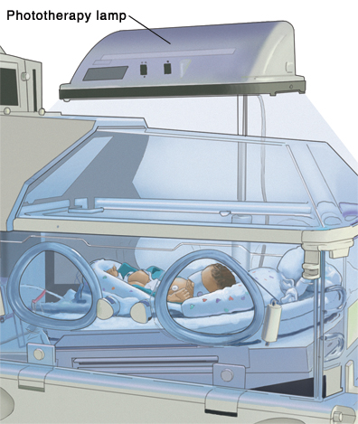 Baby with eyes covered under phototherapy lamp in incubator.