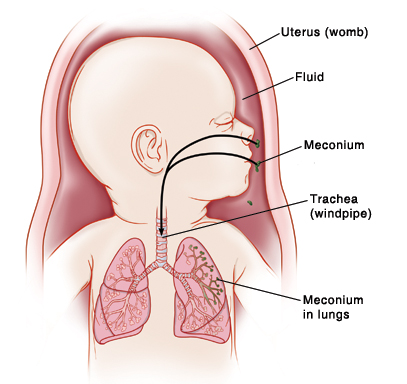 Baby in uterus (womb) with head turned to side showing trachea (windpipe) and lungs. Meconium is in fluid inside womb. Arrows show meconium going through nose and mouth into lungs.
