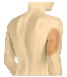 Back of arm showing red rash in bull's eye shape.