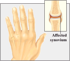 Back view of hand with large joints. Closeup of inside of joint showing inflamed joint lining.