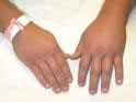 Bee Sting of Left Hand