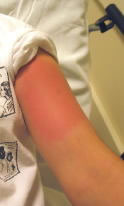 Bee Sting of Upper Arm