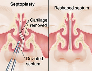 Before and after front view of face showing sinuses and deviated septum repair.