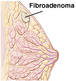 Benign Breast Lumps (fibroadenoma)