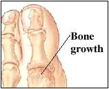 Image of the toe joint showing bone growth