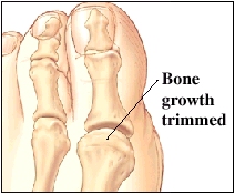 Image of big toe joint showing bone growth trimmed
