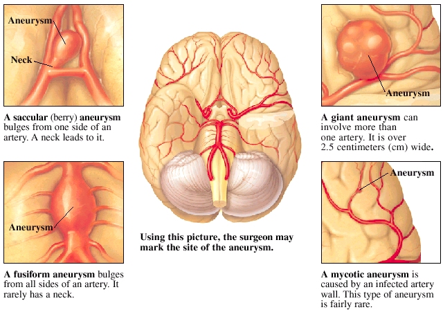 Brain viewed from bottom showing brain stem, cerebellum, and arteries. Closeup of brain showing saccular aneurysm. Closeup of artery with fusiform aneurysm. Closeup of artery with giant aneurysm. Closeup of mycotic aneurysm.