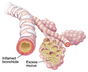 Bronchiole and alveolar sacs with mucus buildup and inflammation because of pneumonia.