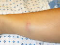 Bruise on Forearm