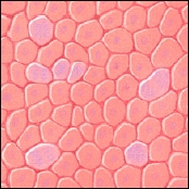 Microscopic view of low-grade cancer cells.