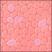 Microscopic view of low-grade cancer cells.