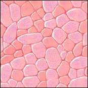 Microscopic view of high-grade cancer cells.