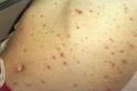 Chickenpox on Abdomen