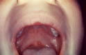 Chickenpox Sores in Mouth