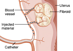 Closeup of fibroid in wall of uterus. Catheter is inserted in blood vessel on uterus and injecting material into smaller vessels near fibroid.