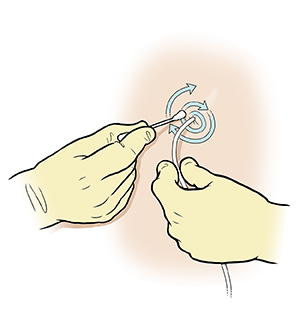 Closeup of gloved hands cleaning site around IV catheter with cotton swab in a spiral pattern.
