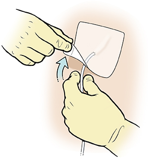 Closeup of gloved hands removing dressing from IV catheter.