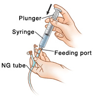 Closeup of hand holding NG tube with syringe inserted into feeding port. Other hand is pushing down plunger of syringe to flush water into tubing.