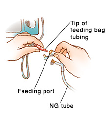 Closeup of hands connecting feeding bag tubing to port on extension tubing. Feeding bag tubing is connected to pump.