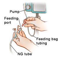 Closeup of hands disconnecting feeding port from feeding bag tubing. Feeding bag tubing is connected to pump.