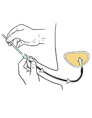 Closeup of hands inserting catheter into penis.  
