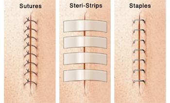 Closeup of incision with sutures. Closeup of incision with Steri-Strips. Closeup of incision with staples.