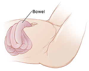 Closeup of infant abdomen showing bowel coming through defect in abdomen.