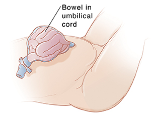 Closeup of infant abdomen showing bowel inside umbilical cord.
