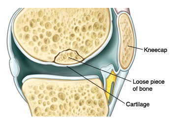 Closeup of knee joint showing loose piece of bone broken off from leg bone but underneath cartilage.