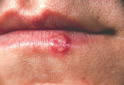 Cold Sore of Lower Lip