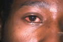 Conjunctivitis - Bacterial