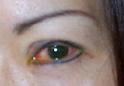 Conjunctivitis - Viral (Pink Eye)