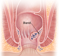 Cross section of anus showing banded hemorrhoid.